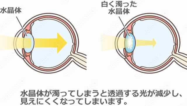 白内障のイメージ画像