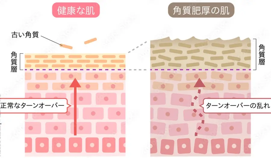 健康な肌の状態と角質肥厚の肌の図解